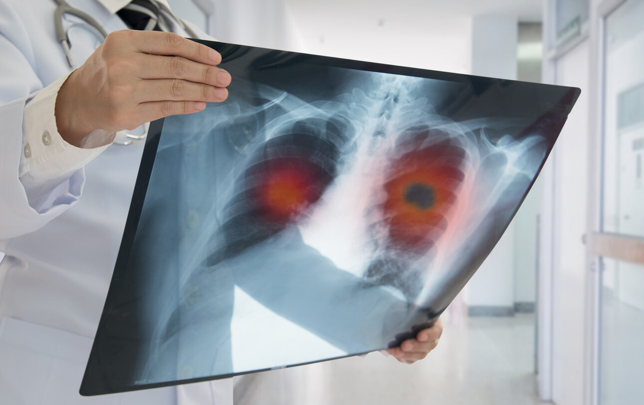 x-ray-lung-cancer